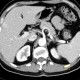 Angiomyolipoma of kidney: CT - Computed tomography